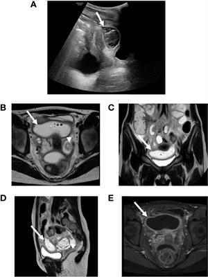 Non-Occlusive Mesenteric Ischemia in Children With Diabetic Ketoacidosis: Case Report and Review of Literature